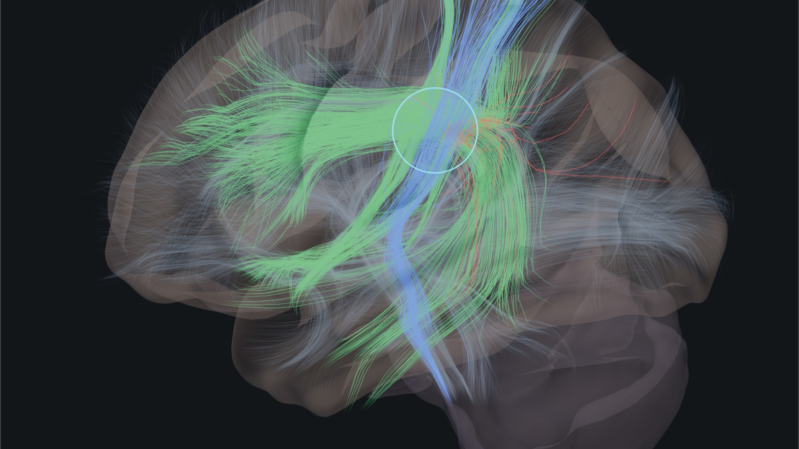 The lesion lab: a translucent sphere in the white matter of the left hemisphere, with the sampled streamlines it cuts drawn along their whole length on the group reference brain.